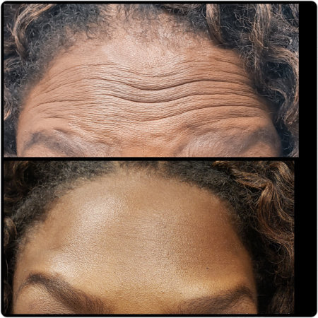 before and after results of botox/dysport on a forehead