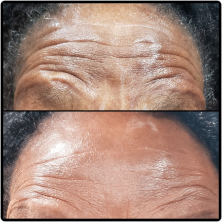 before and after results of botox/dysport on a forehead