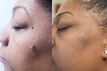 before and after results of skin tag removal of a woman's face