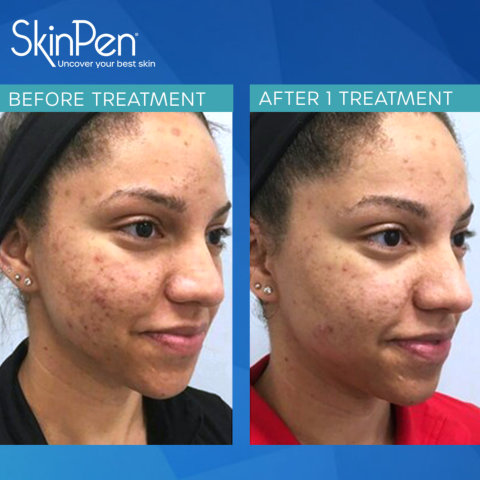 woman before and after using skin pen
