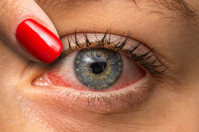 pink-eye-how-it-develops-and-how-to-treat-it