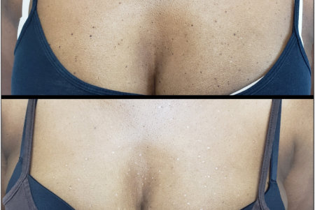 before and after results of skin tag removal of a woman's chest