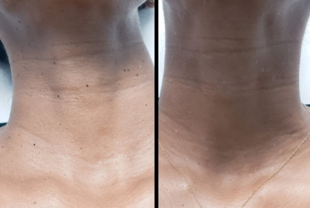 before and after results of skin tag removal of a woman's neck