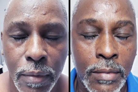 before and after results of skin tag removal of a man's face